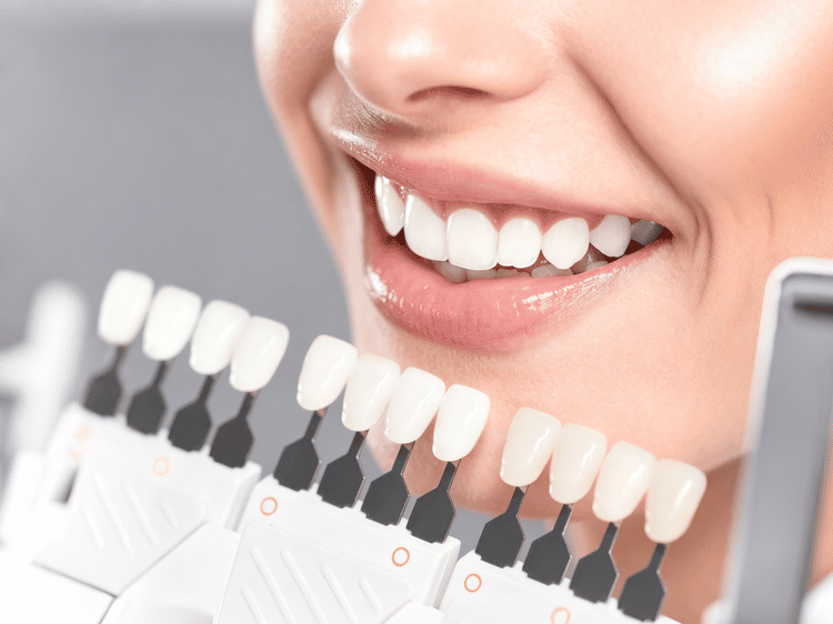 dental veneers in China